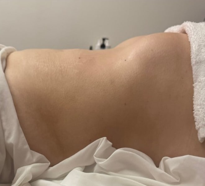 The same client after one Brazilian Lymphatic treatment