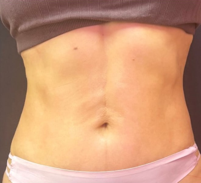 The same client after three Signature Stomach Sculpting sessions
