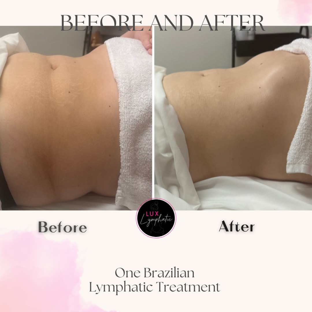 One Brazilian Lymphatic Treatment